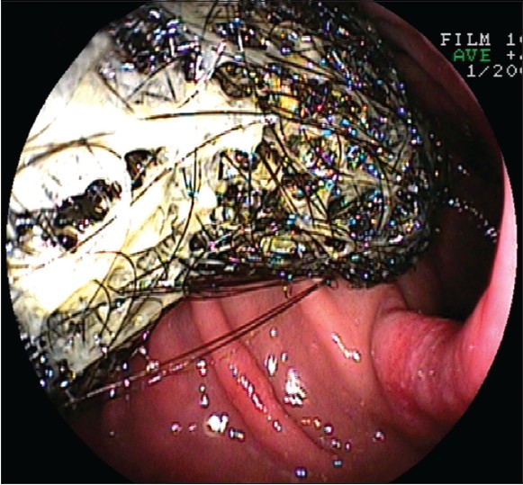 Figure 4: Endoscopy confirming the diagnosis of a trichobezoar