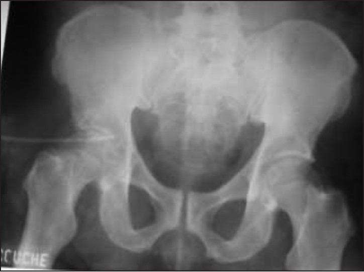 Figure 1: Coventional radiograph pf the pelvis. This shows narrowed hip joint spaces with right worse than left. Note associated right acetabular dysplasia