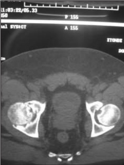 Figure 2: Computed tomogram of the pelvis in osteoarthritis with narrowed right hip joint space with scalloped acetabular margin