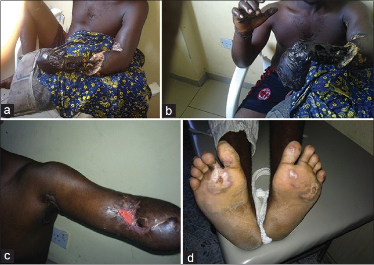 Figure 2: (a) Gangrenous left hand with exposed forearm bones, (b) Gangrenous left hand with exposed forearm bones, (c) Above elbow amputation following electrical burns, (d) Exit points, soles of both feet