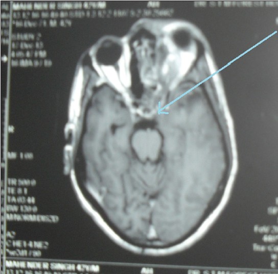 Figure 2: Magnetic resonance imaging brain showing large and bulky left cavernous sinus (blue arrow)