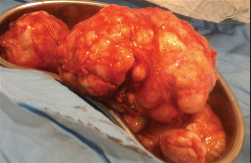 Figure 2: The fibroid nodules were often >5 cm