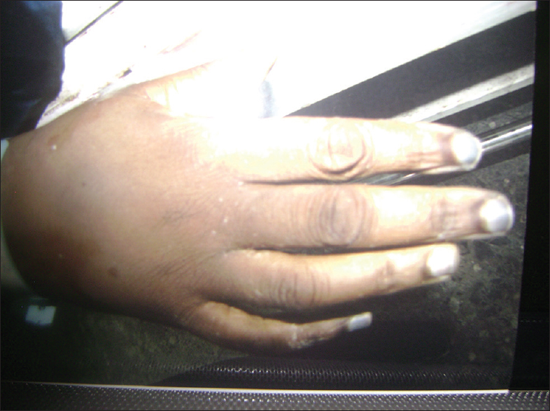 Figure 1: Bluish discoloration of finger nails (peripheral cyanosis)